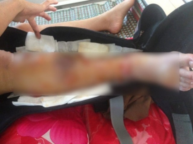 Đắk Lắk: Nữ sinh xinh xắn, học giỏi mất chân vì bác sĩ tắc trách