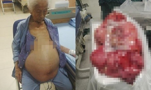 Đồng Nai: Phẫu thuật lấy khối u nặng 13 kg từ bụng bà cụ 100 tuổi