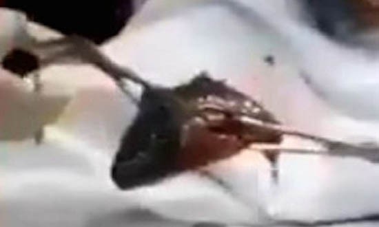 Bác sĩ gắp cá rô còn sống từ cổ họng bệnh nhân